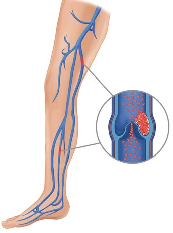 Cause of the varicose veins(1)