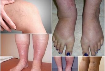 Pictures of venous veins on the legs