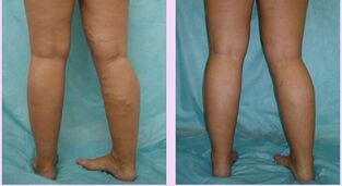 How does varicose veins manifest in the first stage