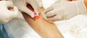 varicose veins surgery