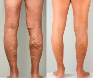 Stages of varicose leg veins