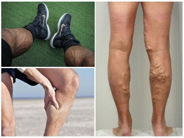 What do varicose veins on men's legs look like