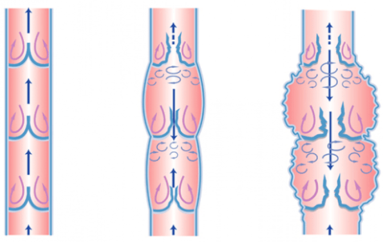 phlebeurysm