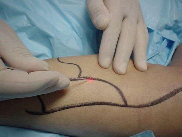 laser varicose veins treatment