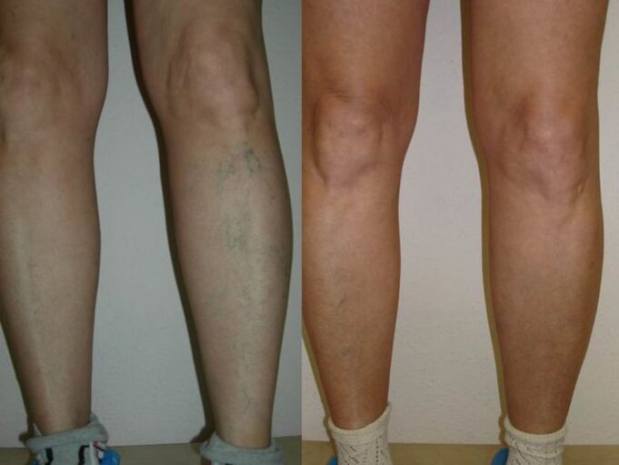legs before and after laser varicose veins treatment