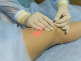 The varicose veins treatment, laser