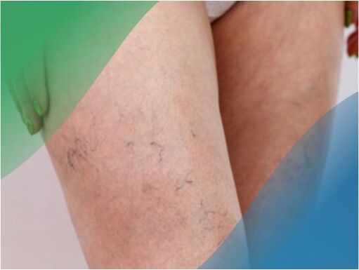 The network of blood vessels in the legs is one of the symptoms of varicose veins