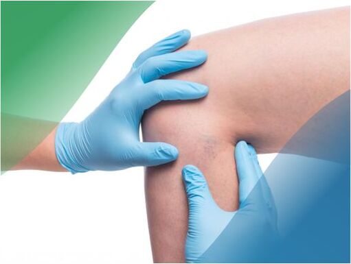 Vein doctor examines the lower extremities affected by varicose veins