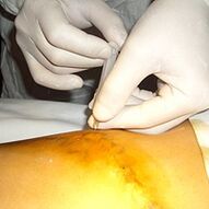 Small varicose veins are the most aesthetic treatment for varicose veins. 