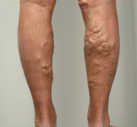 Varicose veins in legs