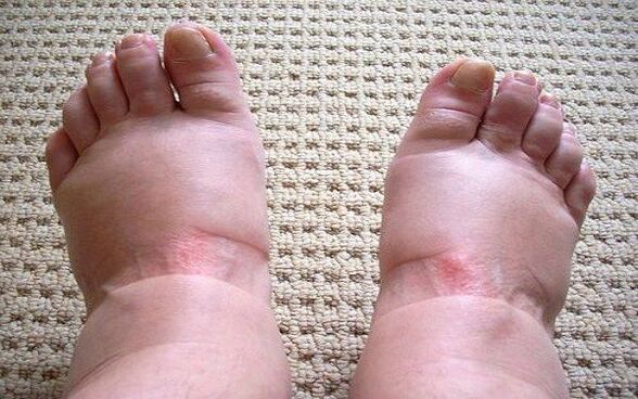 Swollen legs with varicose veins