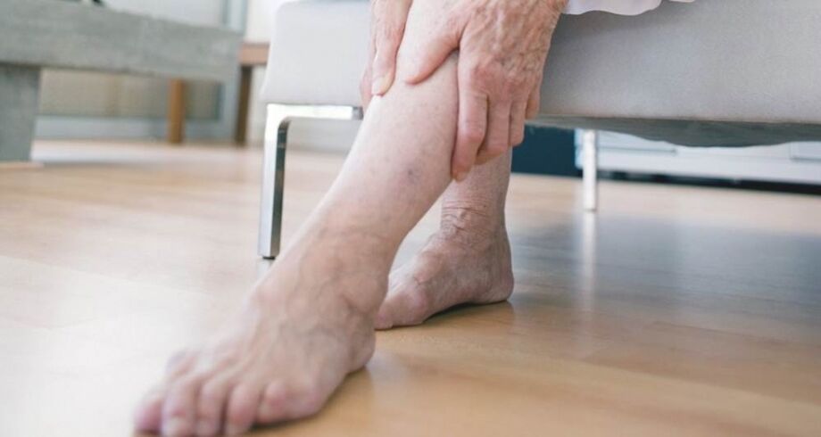 Varicose veins of the lower extremities due to a damaged venous valve