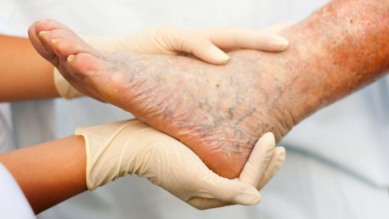 Veterinarian treats varicose veins in the legs