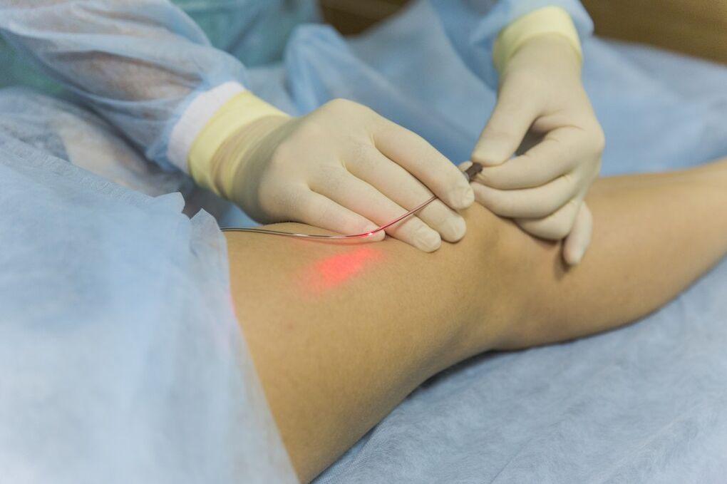 Laser treatment of lower limb varicose veins