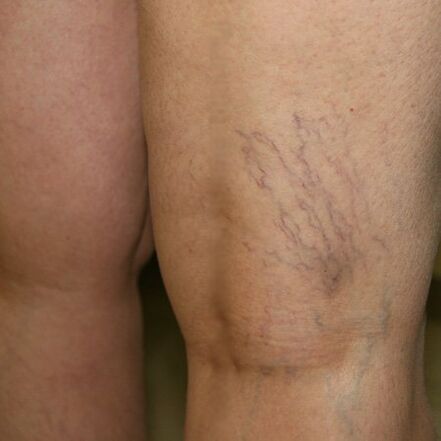 The veins of the lower extremities are a sign of varicose veins