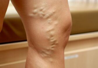 Varicose veins in women's legs
