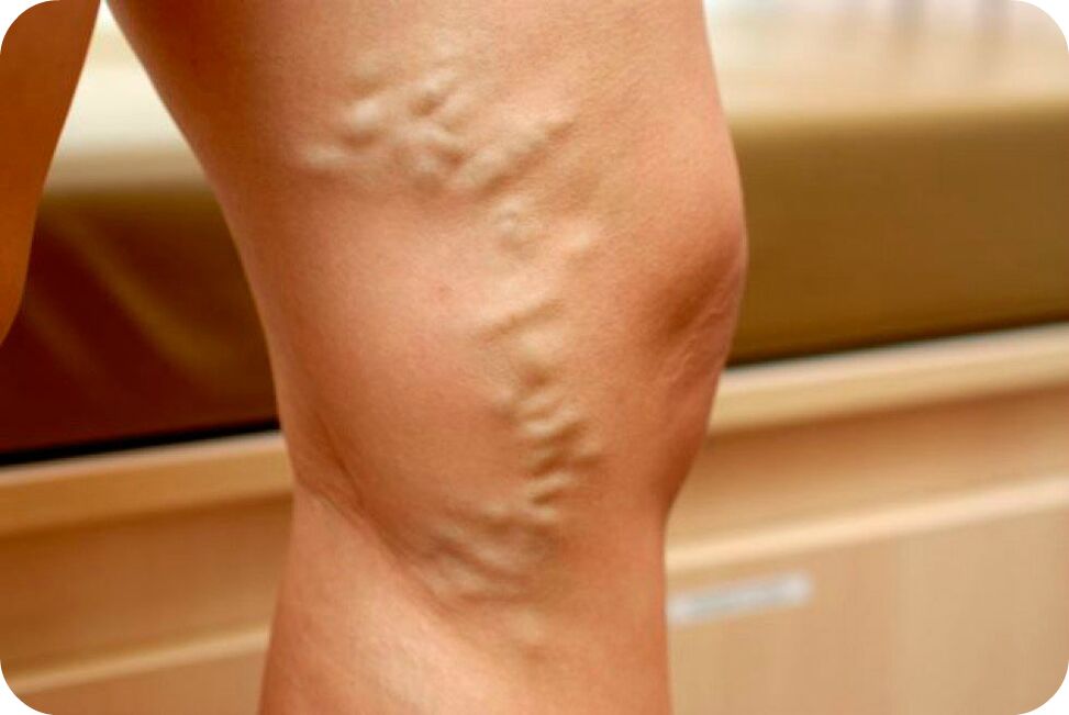 Intravenous veins of veins
