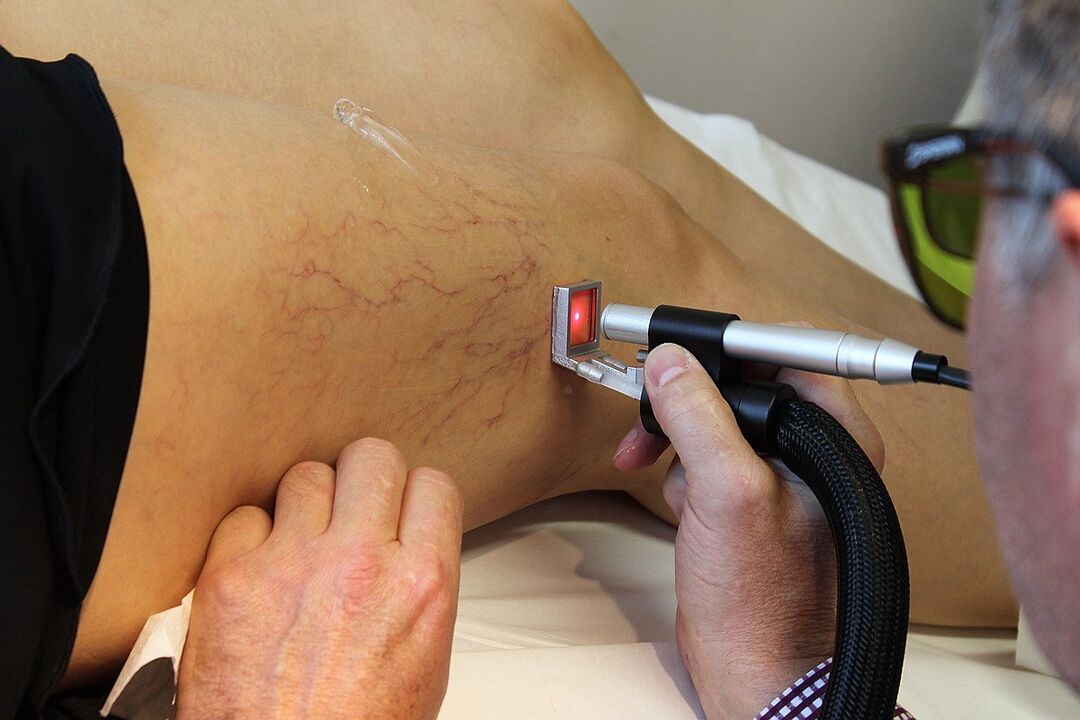Laser blood clotting