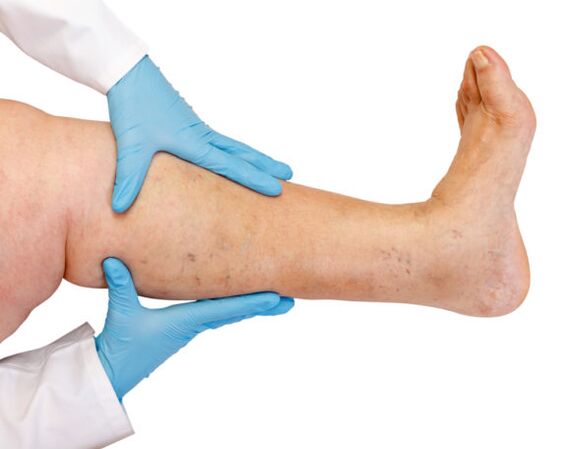 Intravenous veins on the legs