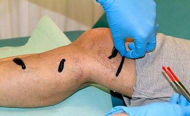 Hirud therapy for varicose veins