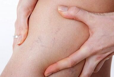 The prohibited actions for varicose veins
