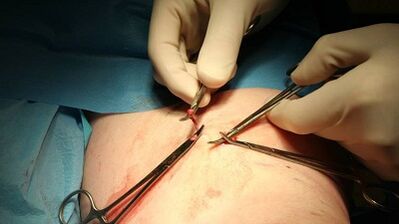 FleeBectomy for varicose veins