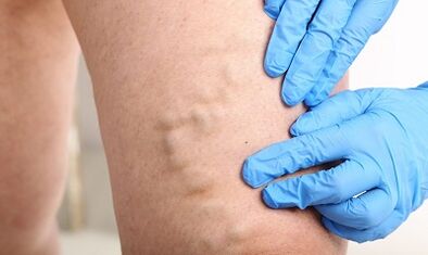 Intravenous veins on the legs