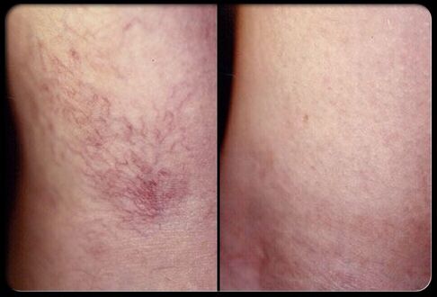 Before and after stiff therapy