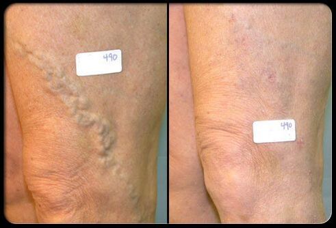 Before and after surgery in veins