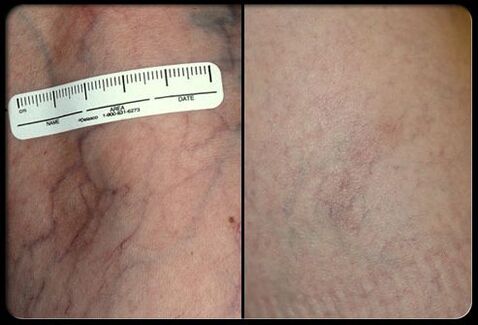 Before and after the laser treatment procedure