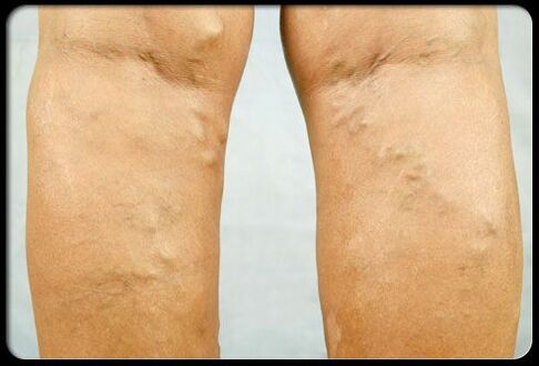 Intravenous veins on the legs