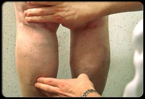 The doctor checks the legs with varicose veins
