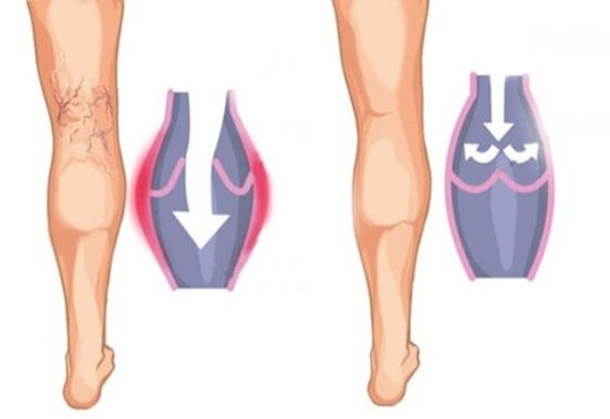 What do varicose veins look like