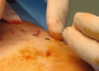 Removal of small veins
