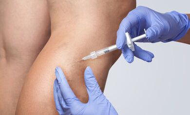 Varicose vein treatment