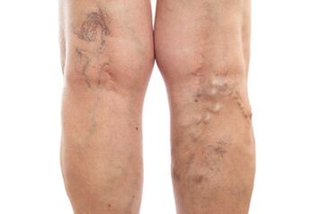 varicose veins of the lower limbs