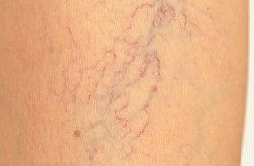 In the initial stages of varicose veins
