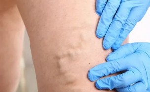 Treatment of varicose veins using a bioadhesive